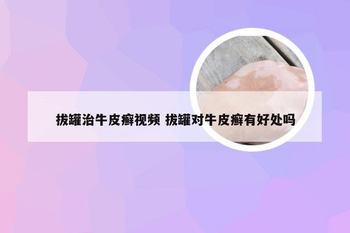 拔罐治牛皮癣视频 拔罐对牛皮癣有好处吗