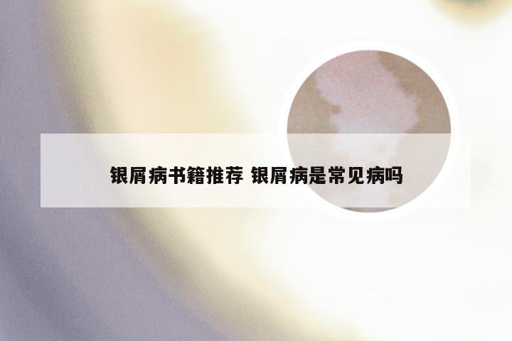 银屑病书籍推荐 银屑病是常见病吗