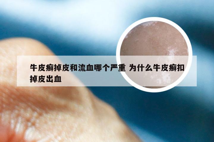牛皮癣掉皮和流血哪个严重 为什么牛皮癣扣掉皮出血