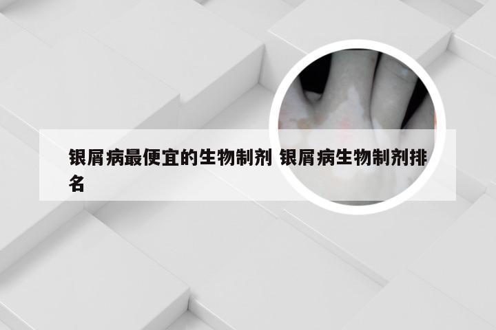 银屑病最便宜的生物制剂 银屑病生物制剂排名
