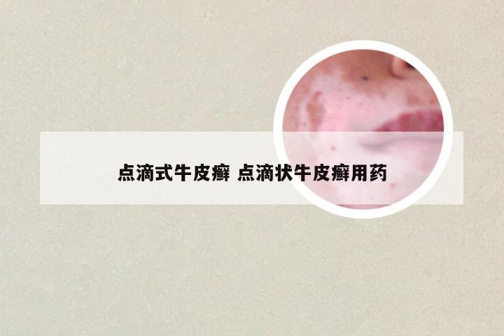点滴式牛皮癣 点滴状牛皮癣用药