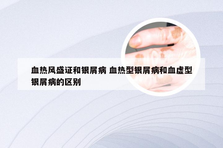 血热风盛证和银屑病 血热型银屑病和血虚型银屑病的区别