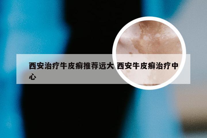 西安治疗牛皮癣推荐远大 西安牛皮癣治疗中心