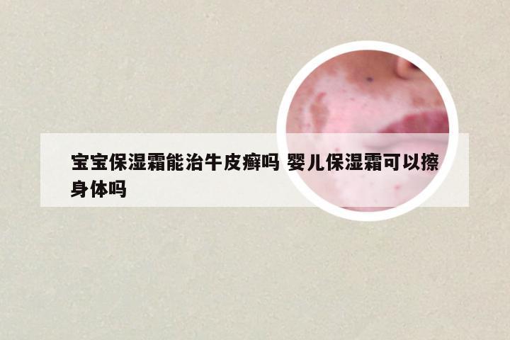 宝宝保湿霜能治牛皮癣吗 婴儿保湿霜可以擦身体吗