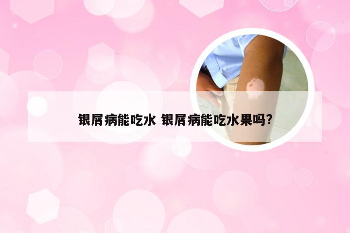 银屑病能吃水 银屑病能吃水果吗?