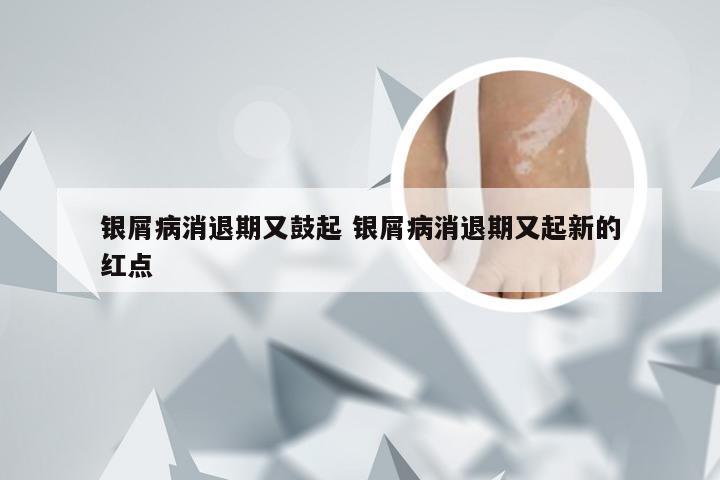 银屑病消退期又鼓起 银屑病消退期又起新的红点