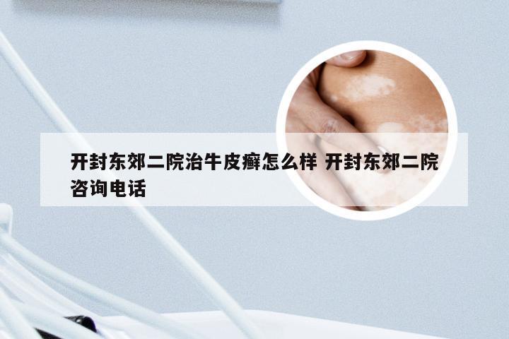 开封东郊二院治牛皮癣怎么样 开封东郊二院咨询电话