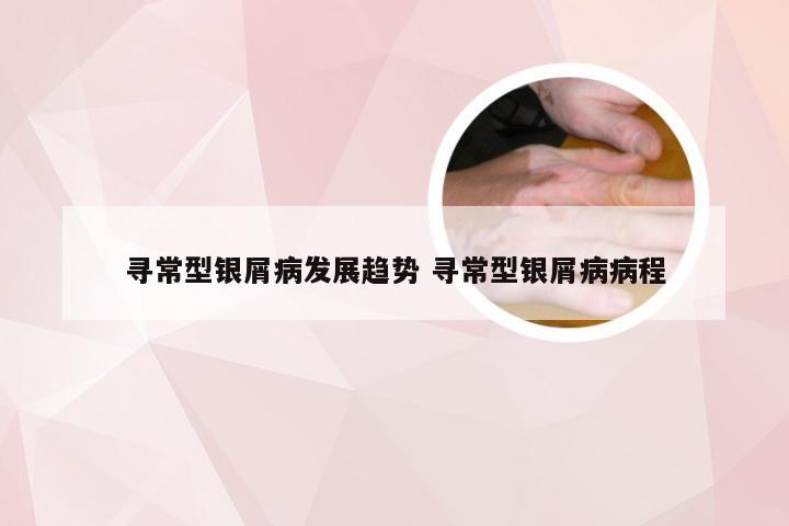 寻常型银屑病发展趋势 寻常型银屑病病程