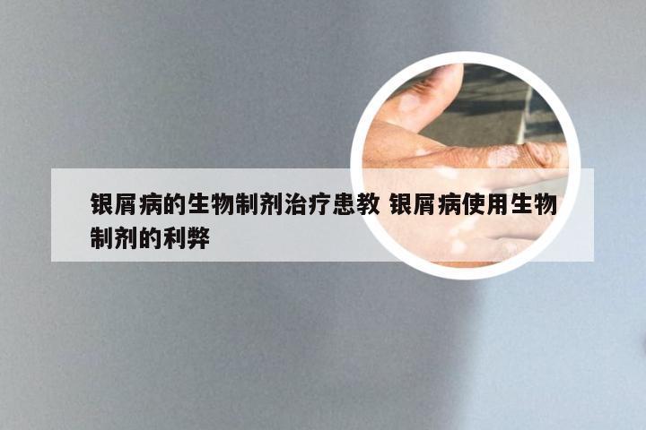 银屑病的生物制剂治疗患教 银屑病使用生物制剂的利弊