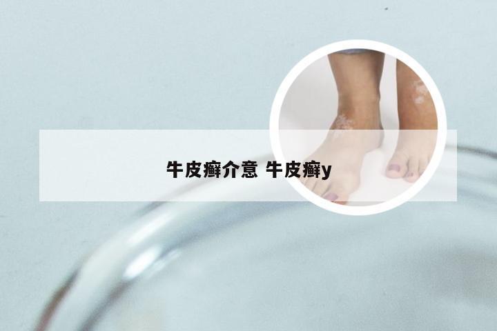 牛皮癣介意 牛皮癣y