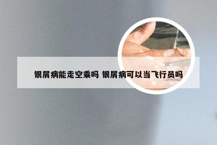 银屑病能走空乘吗 银屑病可以当飞行员吗