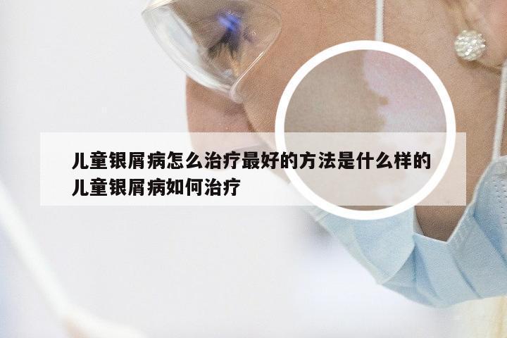 儿童银屑病怎么治疗最好的方法是什么样的 儿童银屑病如何治疗