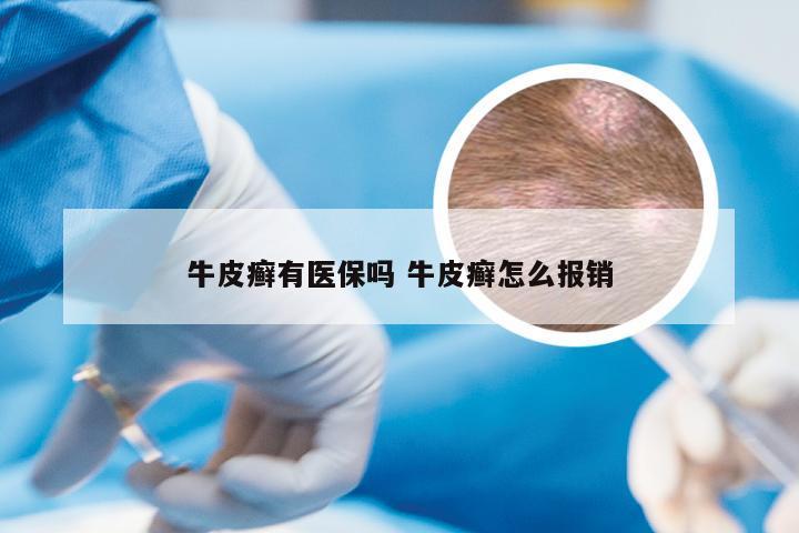 牛皮癣有医保吗 牛皮癣怎么报销