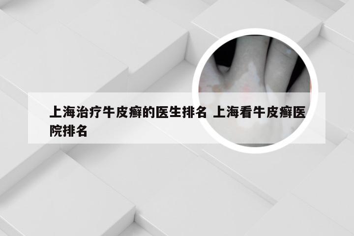 上海治疗牛皮癣的医生排名 上海看牛皮癣医院排名