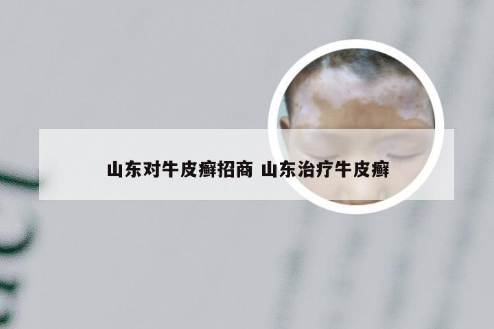 山东对牛皮癣招商 山东治疗牛皮癣