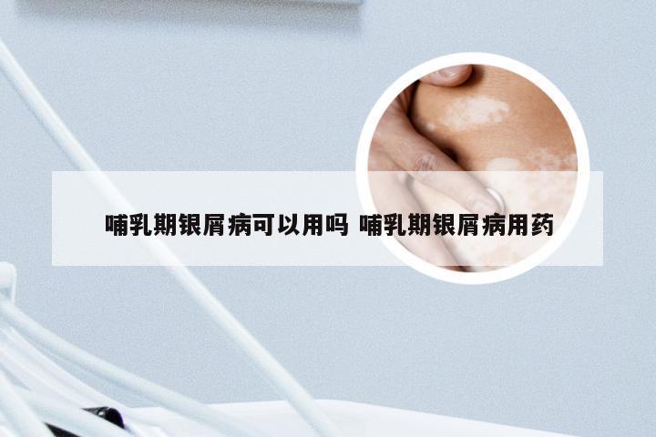 哺乳期银屑病可以用吗 哺乳期银屑病用药