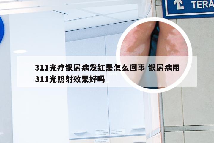 311光疗银屑病发红是怎么回事 银屑病用311光照射效果好吗
