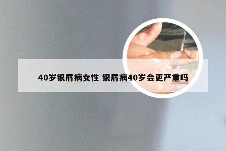 40岁银屑病女性 银屑病40岁会更严重吗