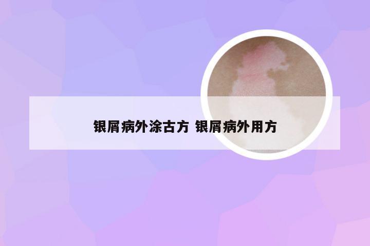 银屑病外涂古方 银屑病外用方