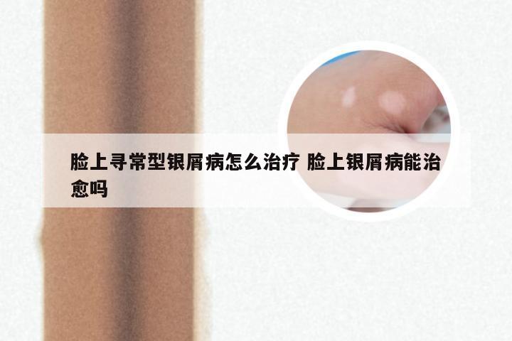 脸上寻常型银屑病怎么治疗 脸上银屑病能治愈吗