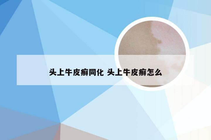 头上牛皮癣同化 头上牛皮癣怎么