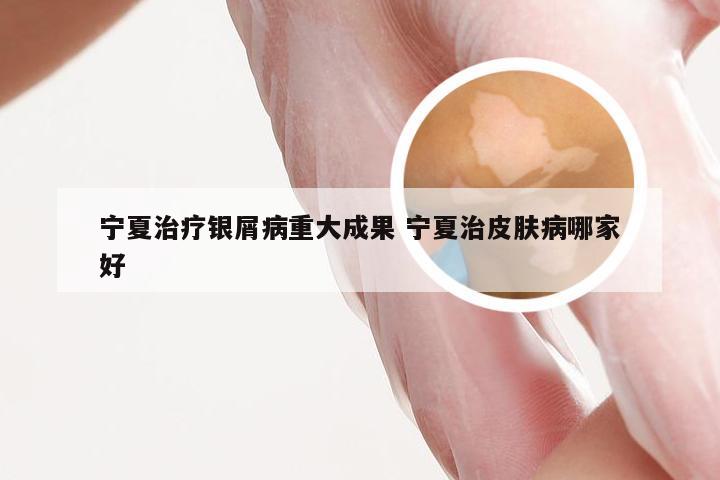 宁夏治疗银屑病重大成果 宁夏治皮肤病哪家好