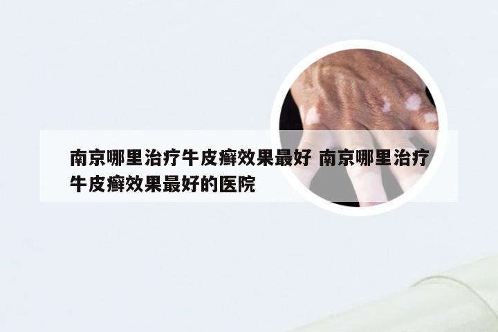 南京哪里治疗牛皮癣效果最好 南京哪里治疗牛皮癣效果最好的医院