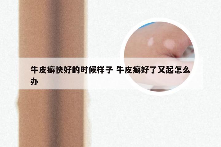 牛皮癣快好的时候样子 牛皮癣好了又起怎么办
