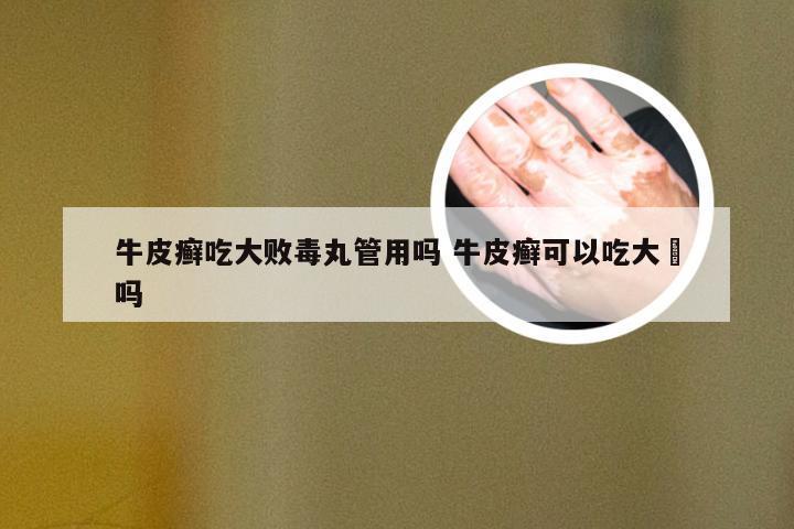 牛皮癣吃大败毒丸管用吗 牛皮癣可以吃大祘吗