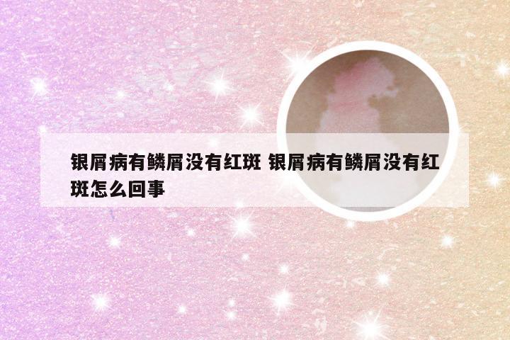 银屑病有鳞屑没有红斑 银屑病有鳞屑没有红斑怎么回事