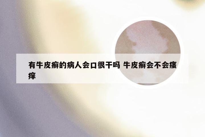 有牛皮癣的病人会口很干吗 牛皮癣会不会瘙痒