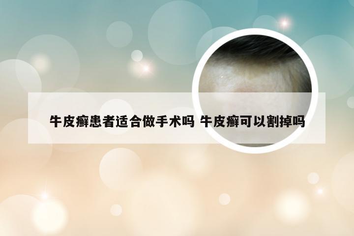 牛皮癣患者适合做手术吗 牛皮癣可以割掉吗