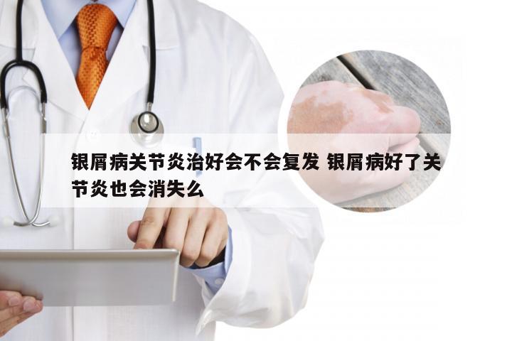 银屑病关节炎治好会不会复发 银屑病好了关节炎也会消失么