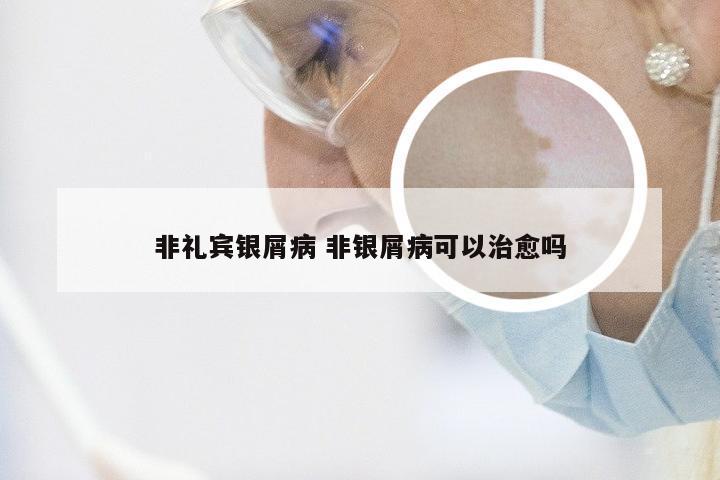 非礼宾银屑病 非银屑病可以治愈吗