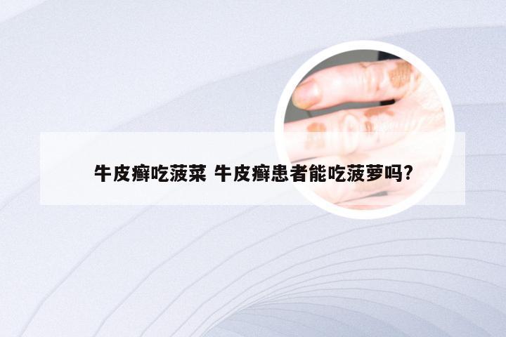 牛皮癣吃菠菜 牛皮癣患者能吃菠萝吗?