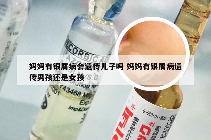 妈妈有银屑病会遗传儿子吗 妈妈有银屑病遗传男孩还是女孩