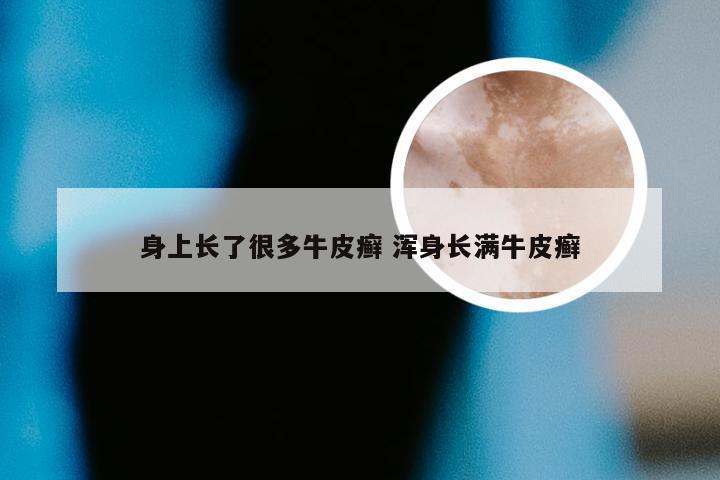 身上长了很多牛皮癣 浑身长满牛皮癣