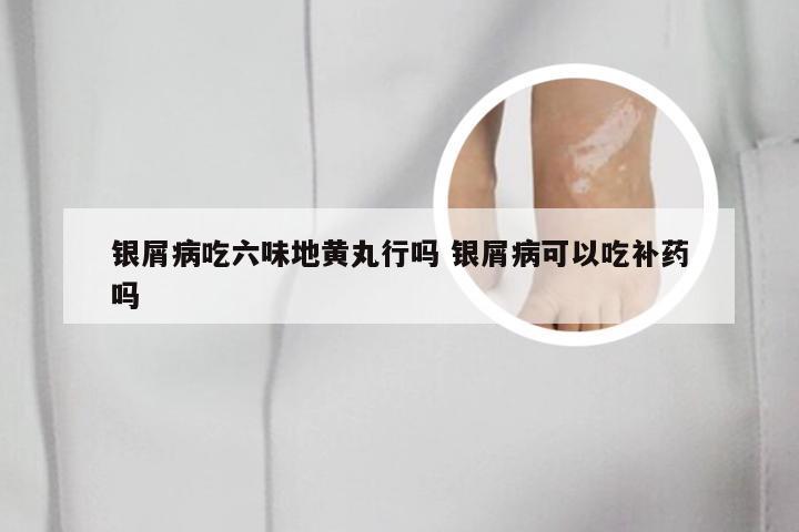 银屑病吃六味地黄丸行吗 银屑病可以吃补药吗