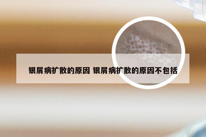 银屑病扩散的原因 银屑病扩散的原因不包括