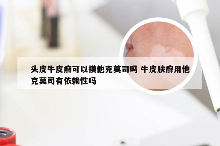 头皮牛皮癣可以摸他克莫司吗 牛皮肤癣用他克莫司有依赖性吗