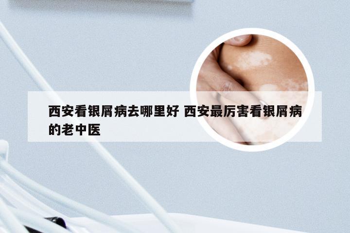 西安看银屑病去哪里好 西安最厉害看银屑病的老中医