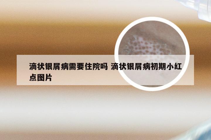 滴状银屑病需要住院吗 滴状银屑病初期小红点图片