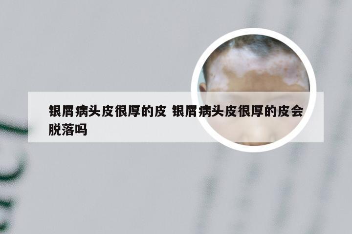 银屑病头皮很厚的皮 银屑病头皮很厚的皮会脱落吗