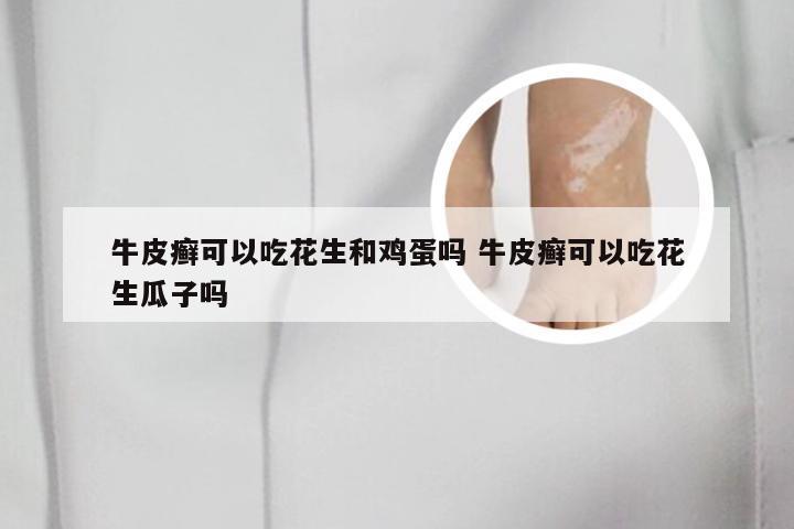 牛皮癣可以吃花生和鸡蛋吗 牛皮癣可以吃花生瓜子吗