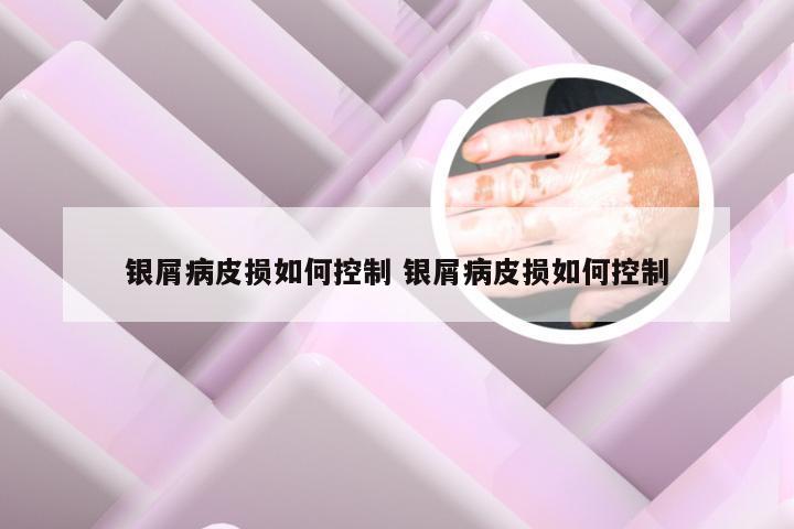 银屑病皮损如何控制 银屑病皮损如何控制