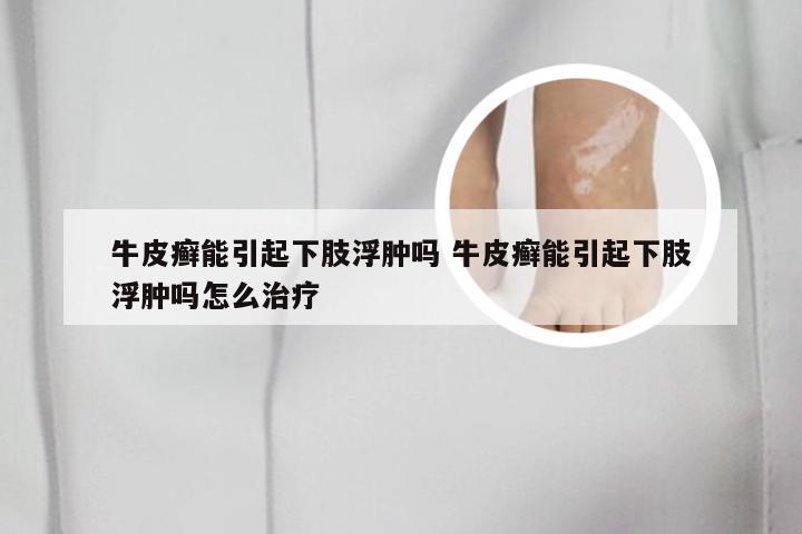 牛皮癣能引起下肢浮肿吗 牛皮癣能引起下肢浮肿吗怎么治疗
