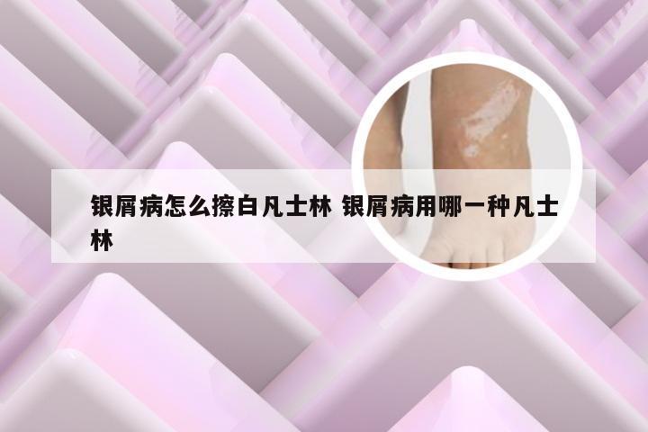 银屑病怎么擦白凡士林 银屑病用哪一种凡士林