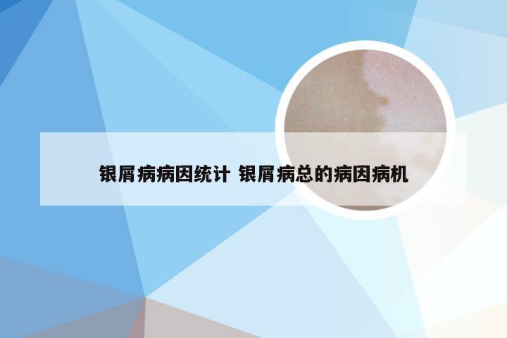 银屑病病因统计 银屑病总的病因病机