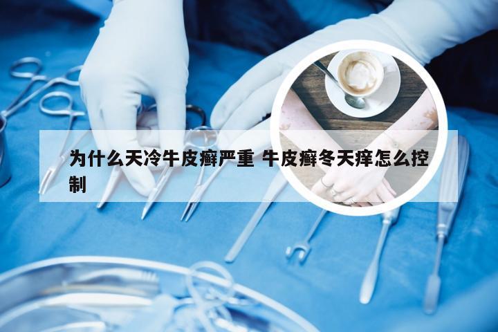 为什么天冷牛皮癣严重 牛皮癣冬天痒怎么控制