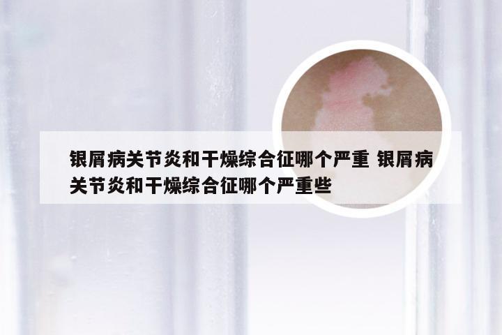 银屑病关节炎和干燥综合征哪个严重 银屑病关节炎和干燥综合征哪个严重些